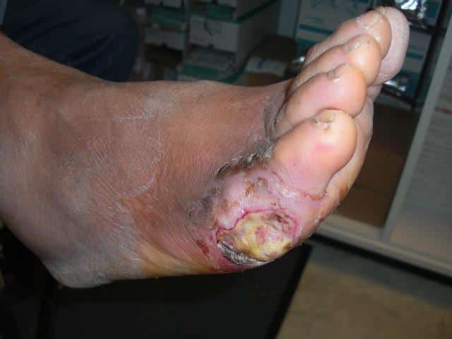 diabetesfuss